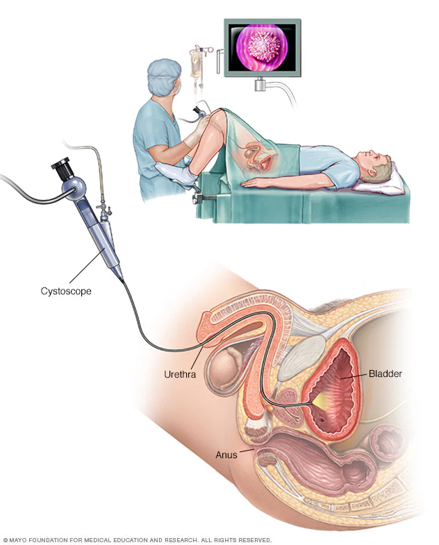 Haematuria Care and Diagnosis