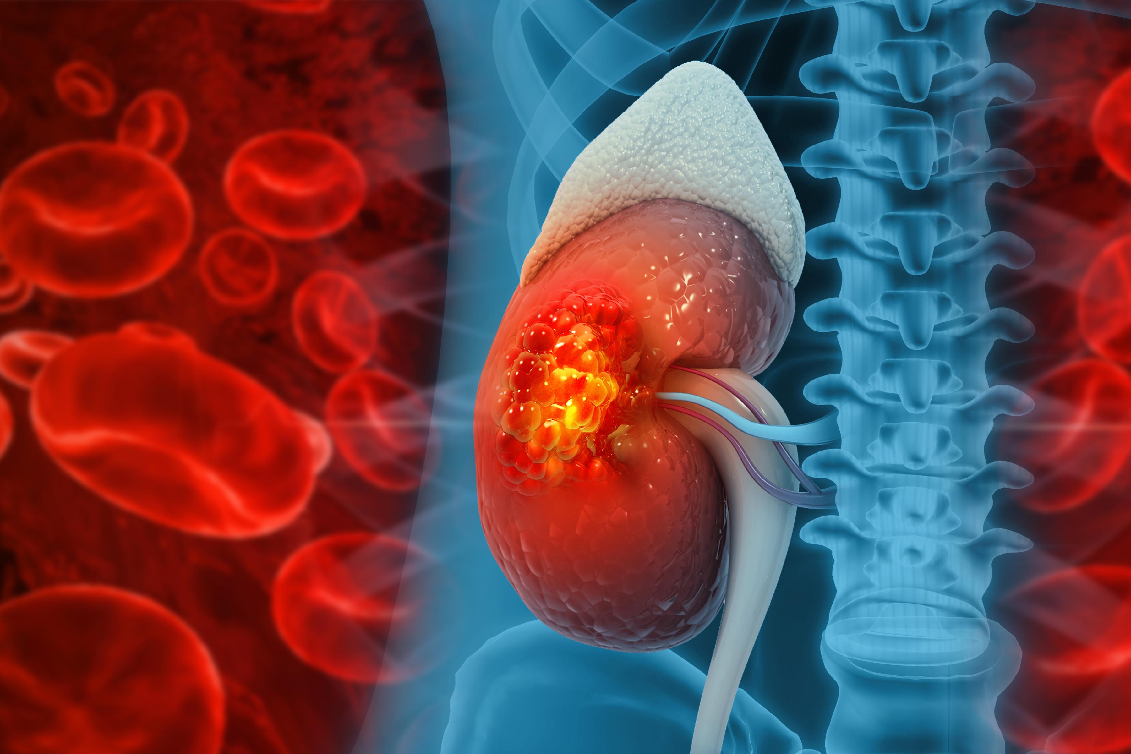 Renal Cancer Care