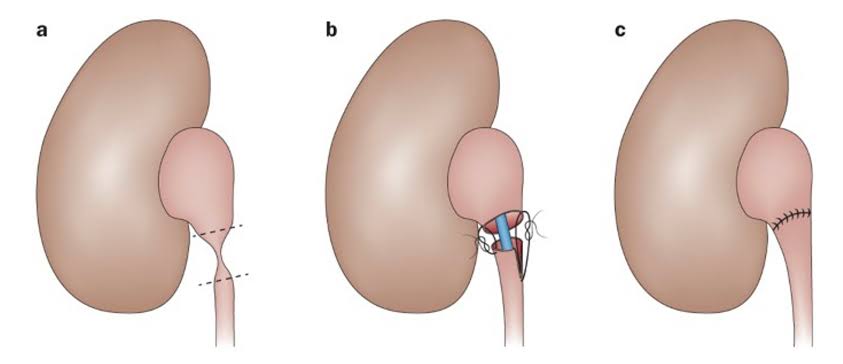 Reconstructive Uro-Surgery