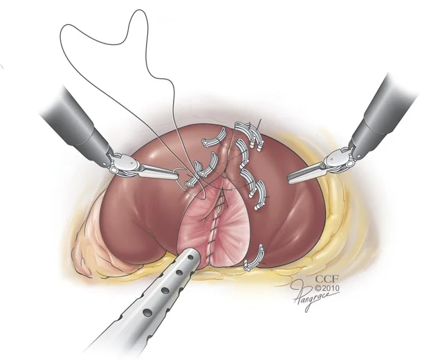 Robotic Kidney Surgery
